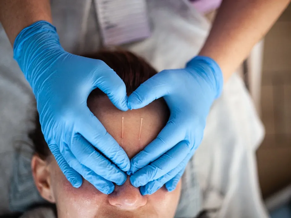 Akupunktura kosmetologiczna w Sylbi