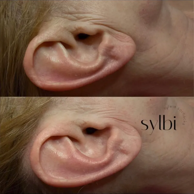 Efekt masażu twarzy — poprawa ukrwienia tkanek po 10 minutach